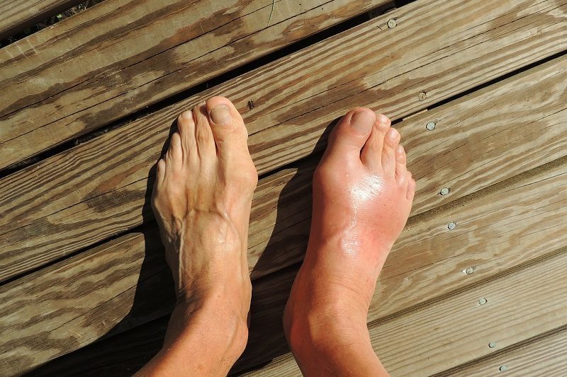 Bunions and Treatment