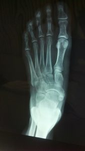 What is a Foot Fracture