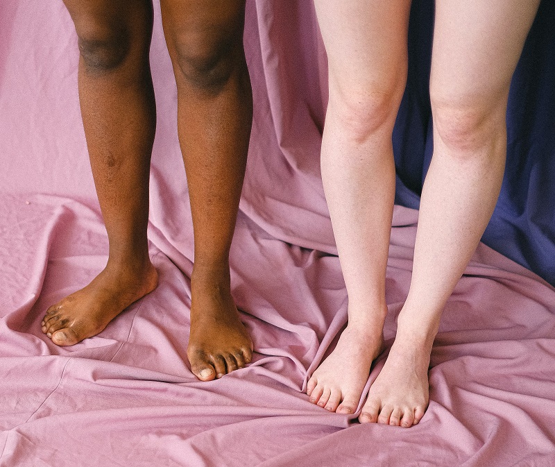 What are bunions? Progressive Footcare